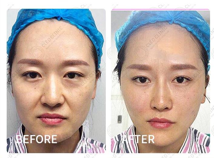 hifu facelift before and after