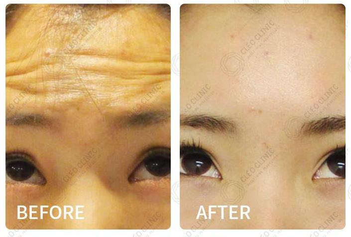 Best Botox Wrinkle Treatment KL, Malaysia - CLEO Clinic