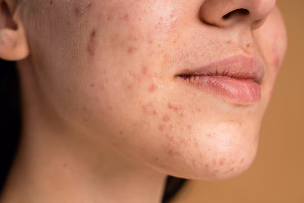 Acne Scarring