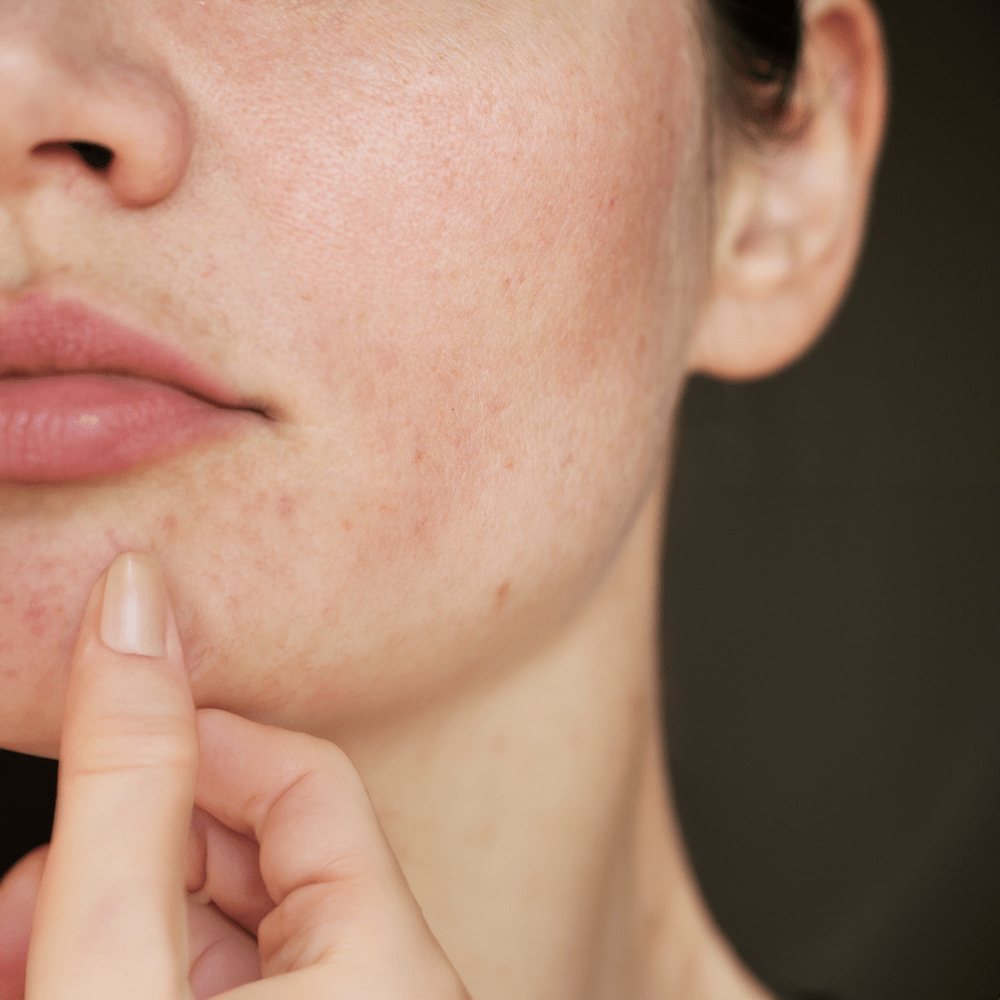 Dull Skin