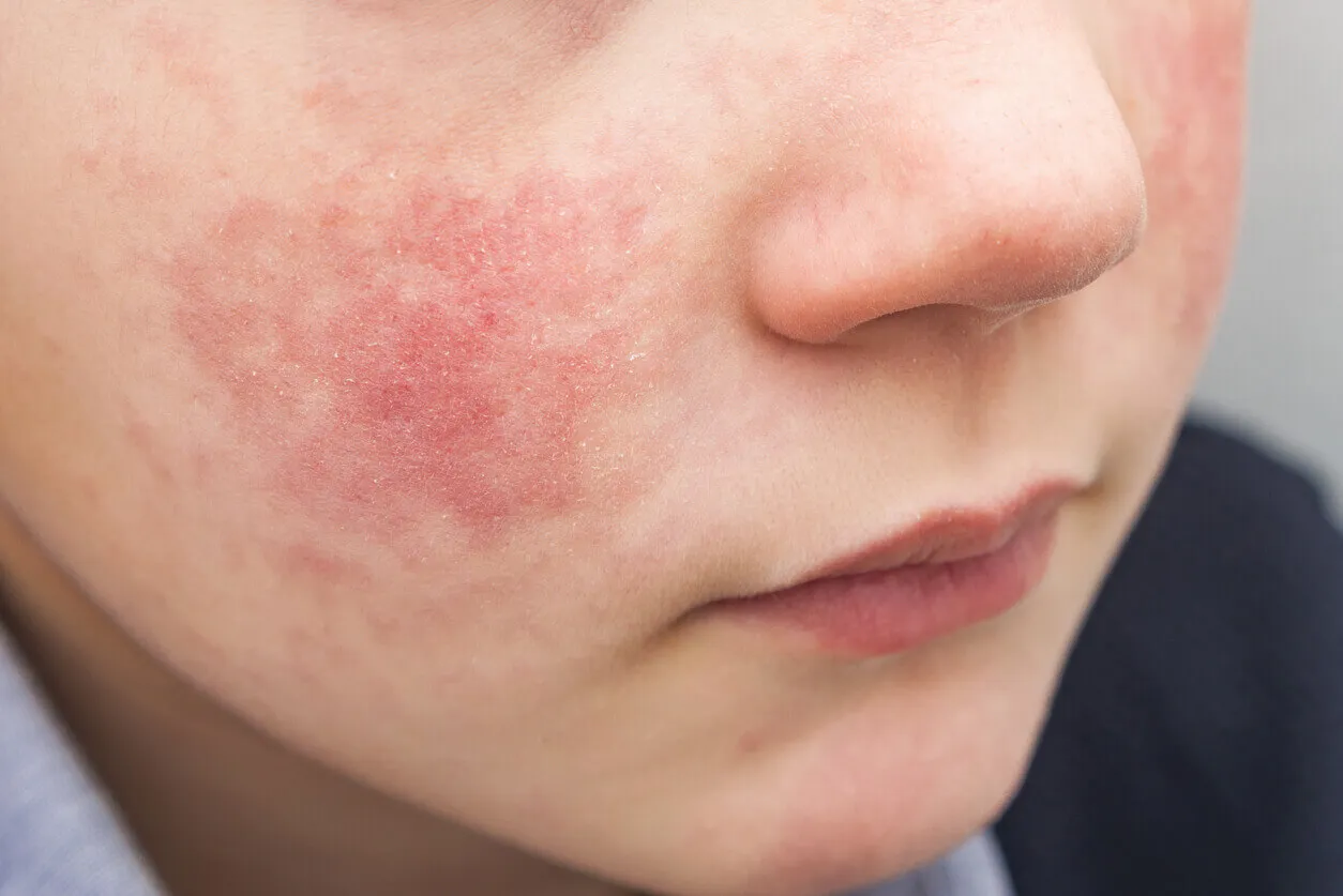 Eczema