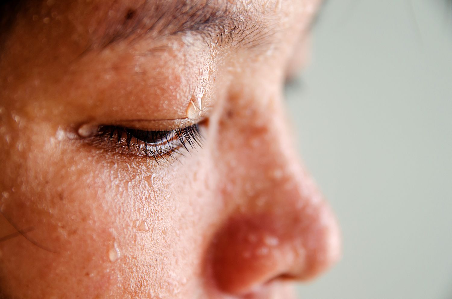 Excessive Sweating