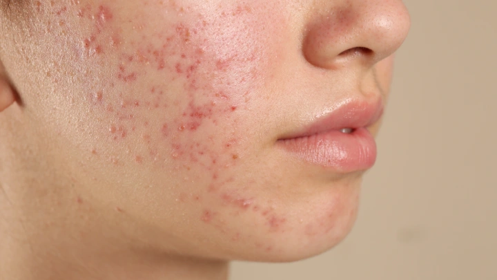 Fungal Skin Infection