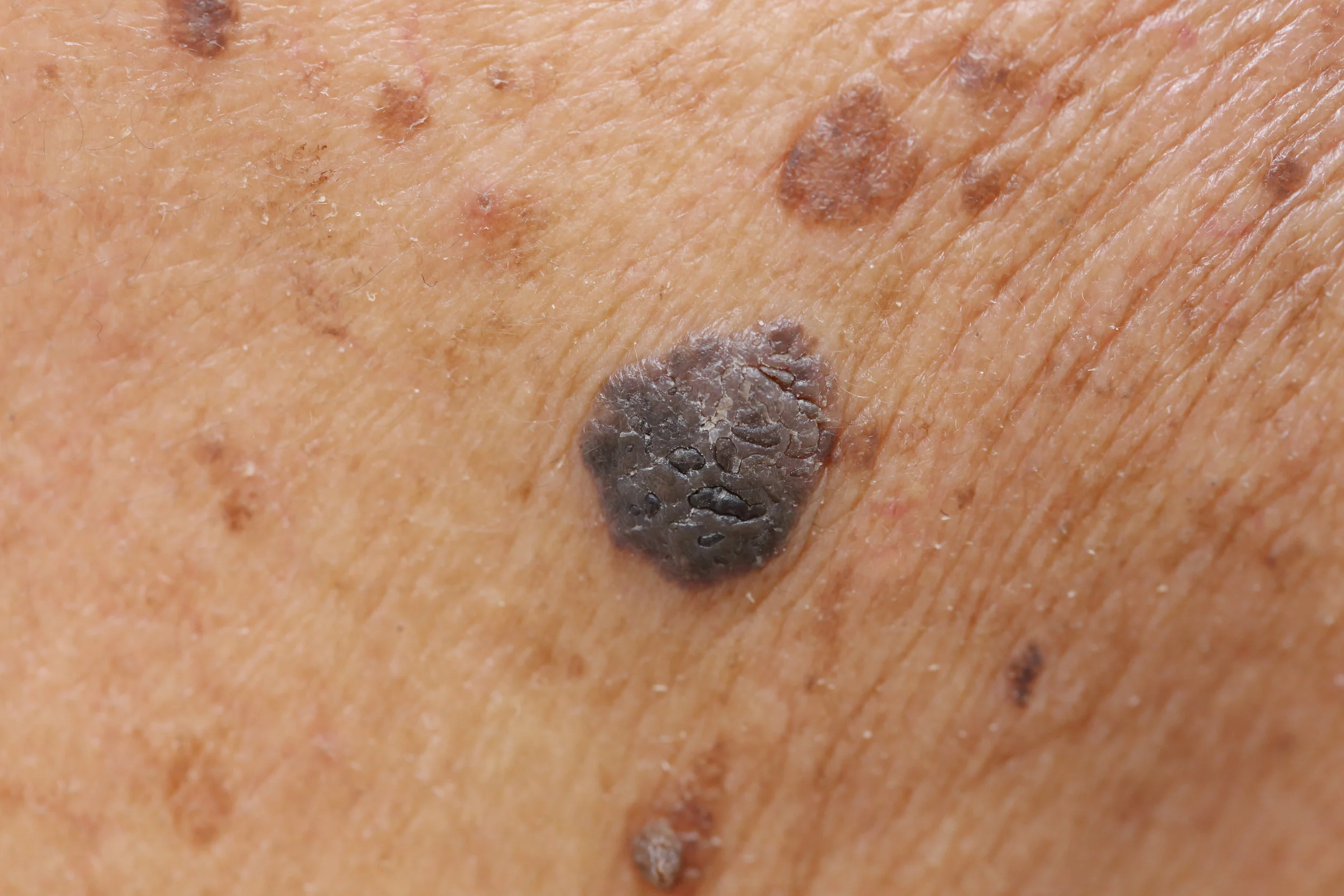 Moles