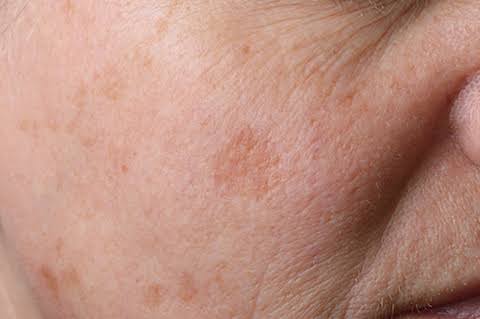 Pigmentation