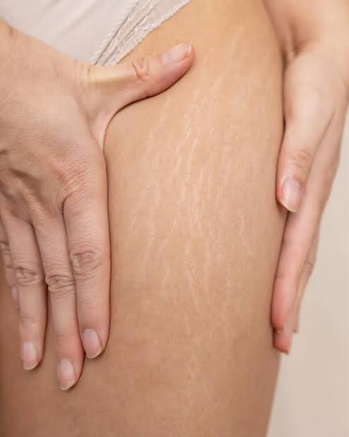 Stretch Marks