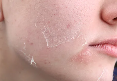 Dry Skin: Causes, Symptoms & Treatment in Malaysia